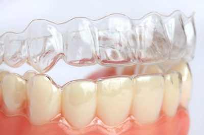 Aparelho dental Invisalign em Mogi Guaçu