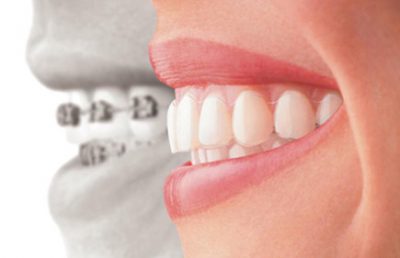 Aparelho dentário invisalign em Mogi Guaçu