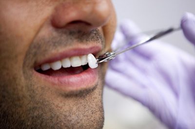 Lente dental em Mogi Guaçu